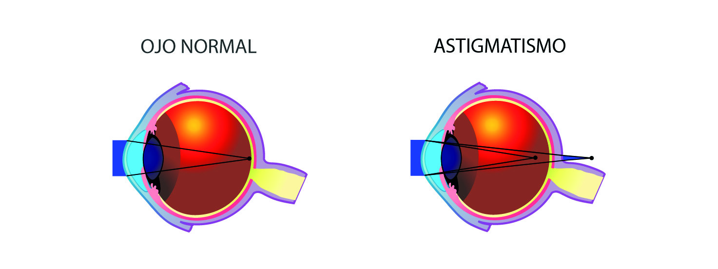 astigmatismo problema visual
