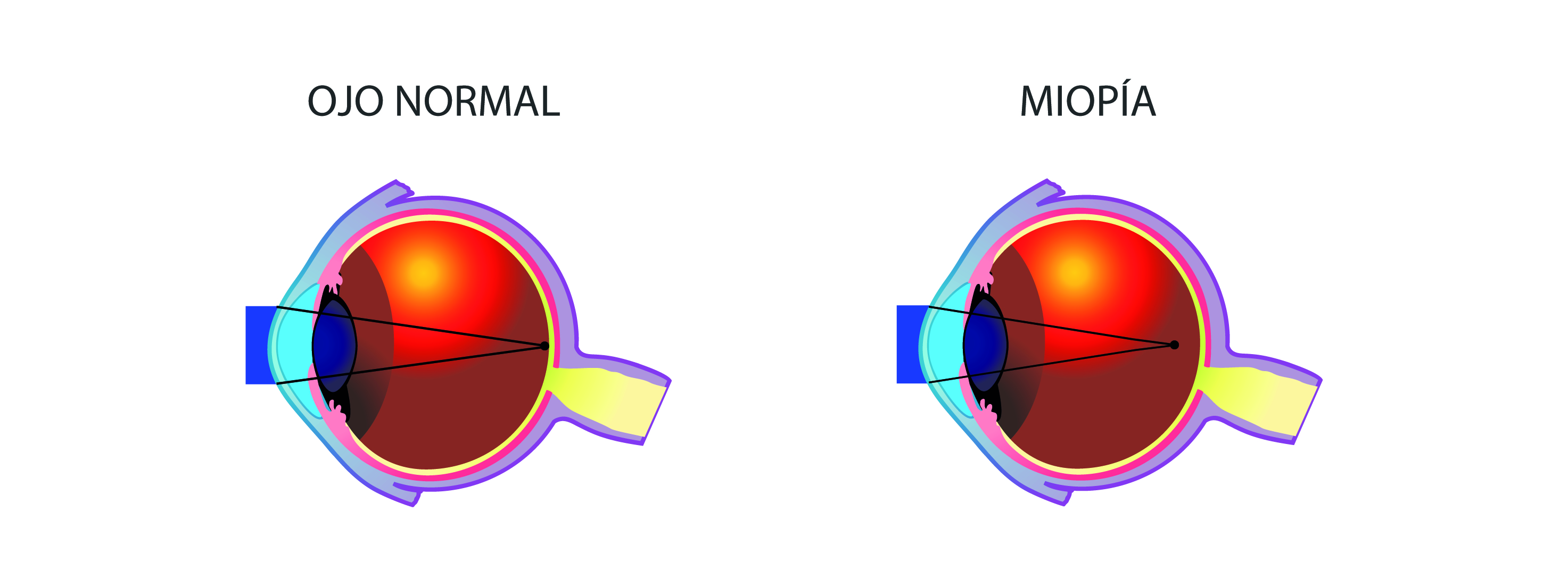 miopía defecto refractivo