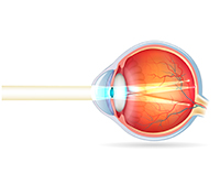ojo con astigmatismo