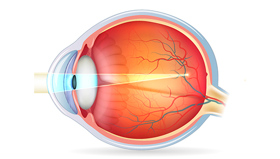 defectos refractivos ojo con alta miopía