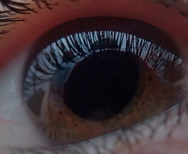 tratamientos superficie ocular córnea