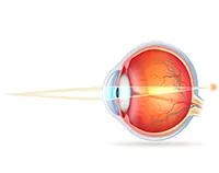 ojo con hipermetropía