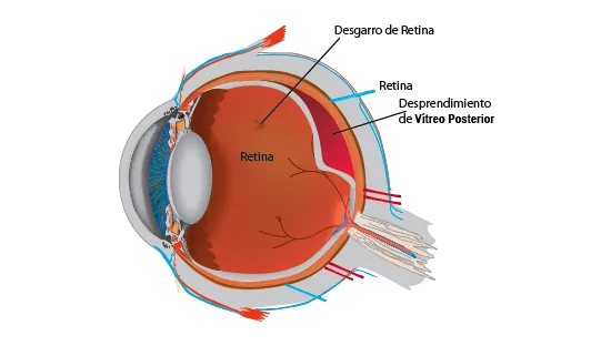 desprendimiento de vítreo ojo