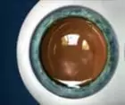 Cirugía refractiva con lente intraocular Mallorca